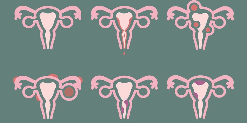 Verschiedene Orte, an denen sich Endometrioseherde ausbreiten können.