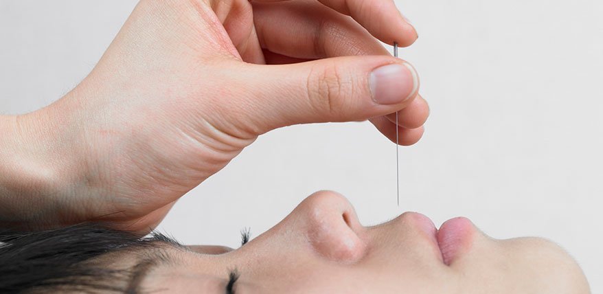 Wie hilft Akupunktur?