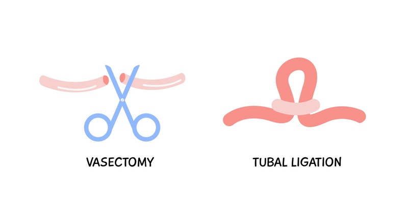 Symbolbild einer Vasektomie und einer Sterilisation.