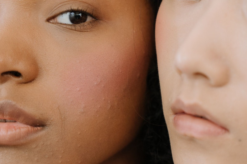 Zwei Frauen mit leichten Hautunreinheiten